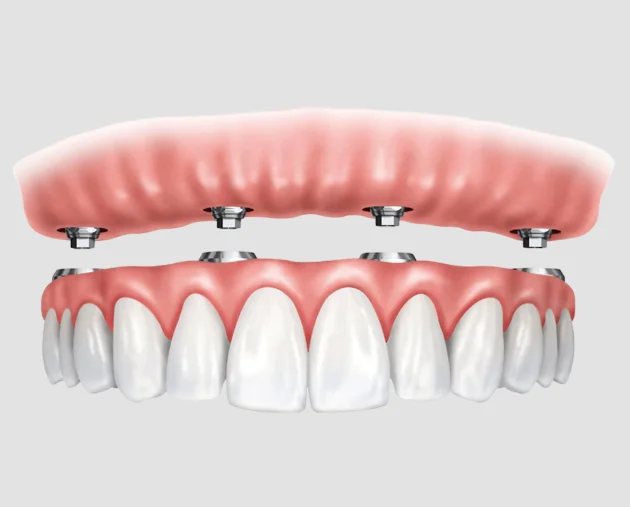 Illustration of full arch dental implants showcasing a top and bottom row of teeth attached to implants, representing all-on-4 dental treatment for complete smile restoration.