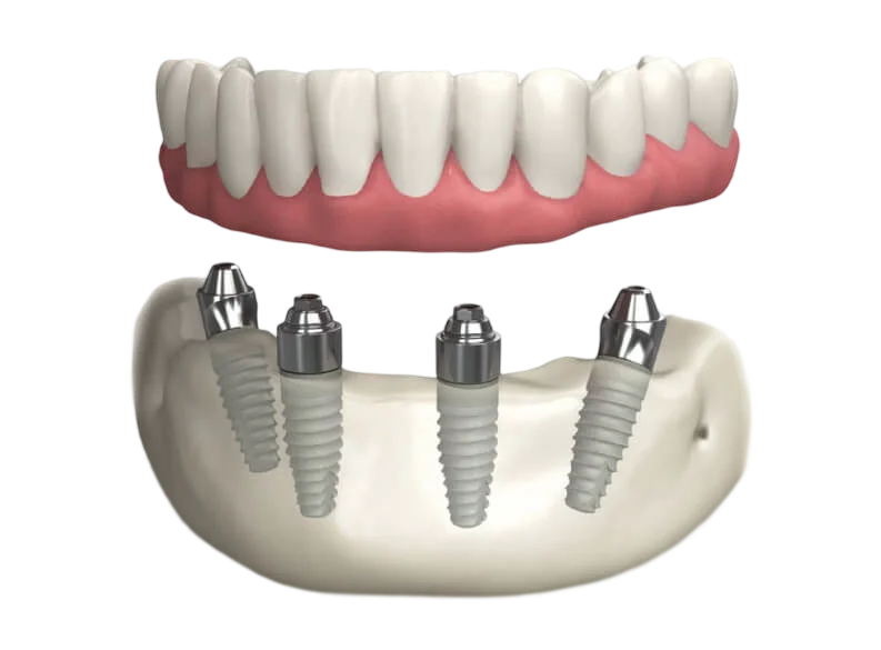New Teeth In Just One Day 3D image structure in Oklahoma City, OK