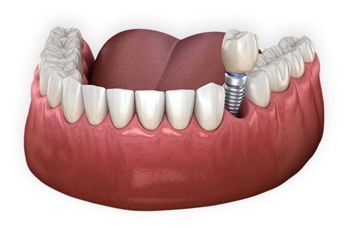Image of the Failed Dental Implants Treatment correction Options available at Oklahoma Implant and Sedation Dentistry 