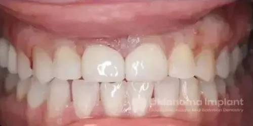 After procedure of Dental Implants in Oklahoma City