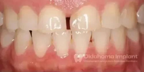 Before procedure of Dental Implants in Oklahoma City